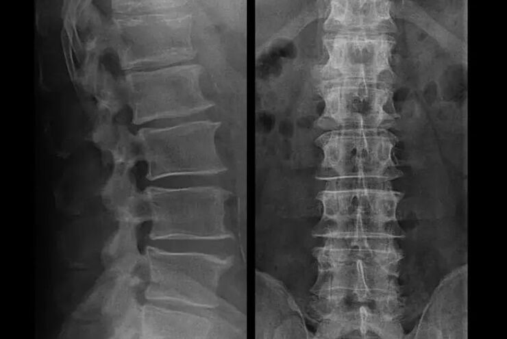 Ostéochondrose à la radiographie